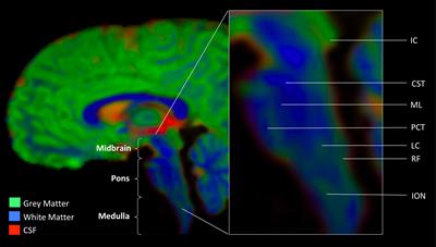 Evidence for Brainstem Contributions to Autism Spectrum Disorders